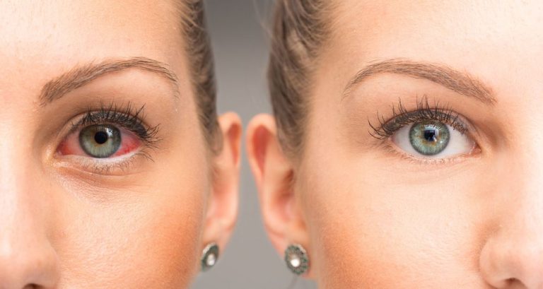 Uveitis treatment